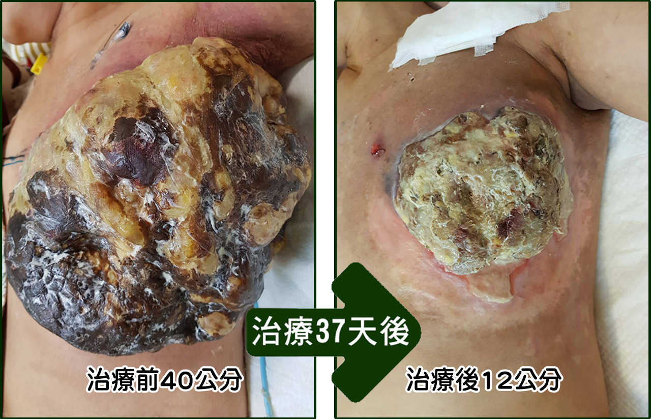 白內障、青光眼、角膜炎治療