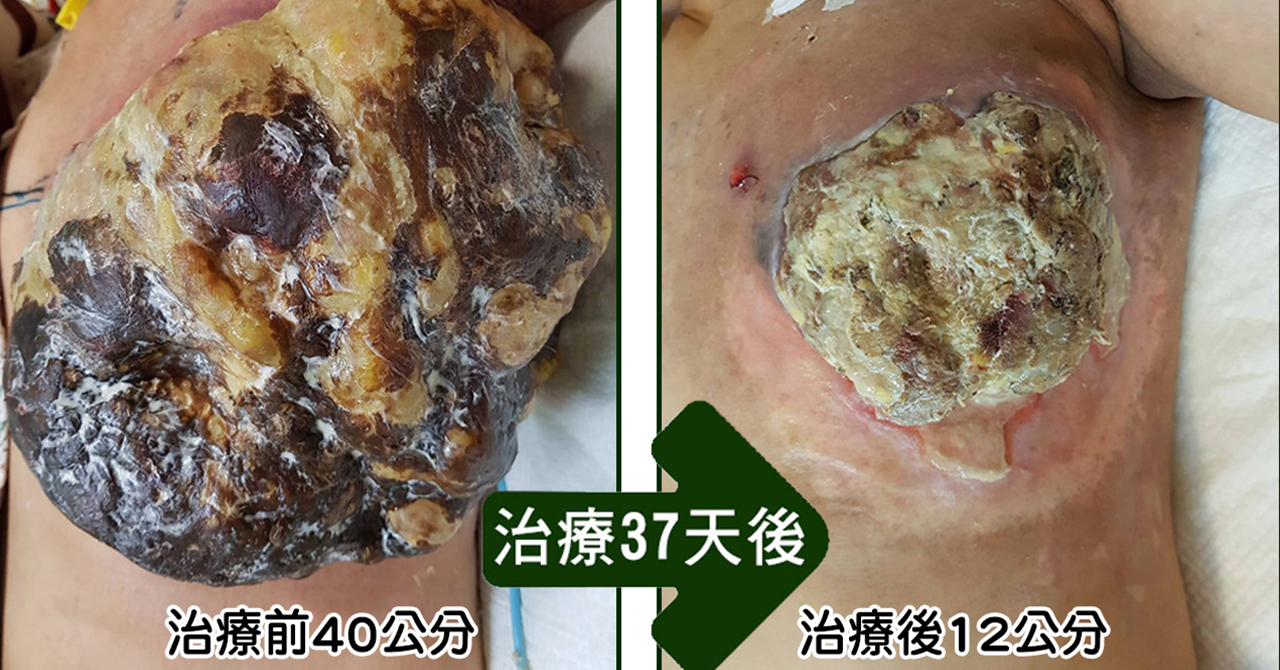 乳癌治療_初次罹患癌症腫瘤治療案例-1