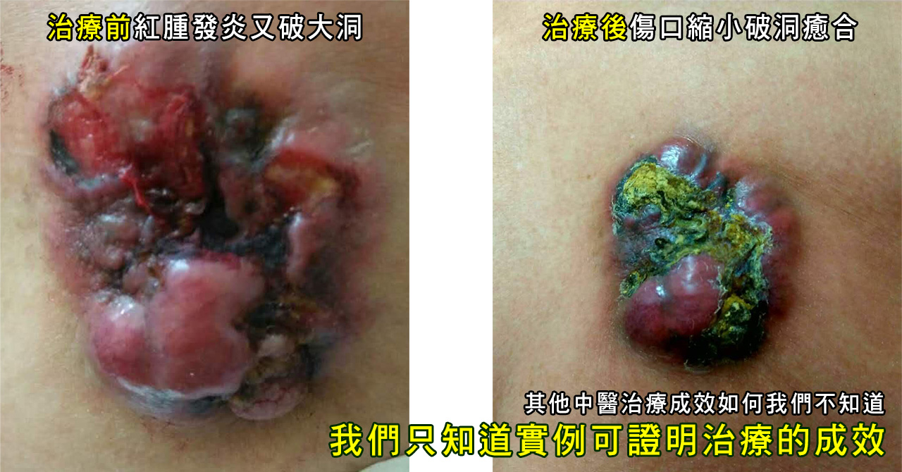 乳癌治療_初次罹患癌症腫瘤治療案例-2