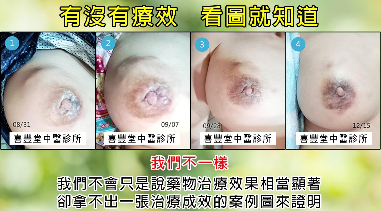 乳癌治療_初次罹患癌症腫瘤治療案例-3
